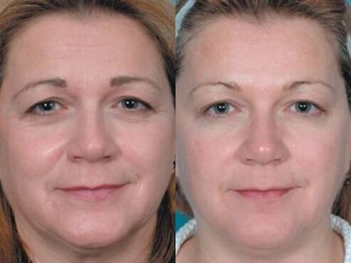 Photos avant et après le rajeunissement de la peau au plasma